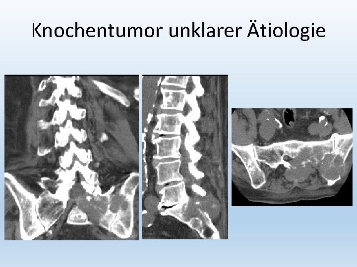 Knochentumor unklarer Ätiologie 
