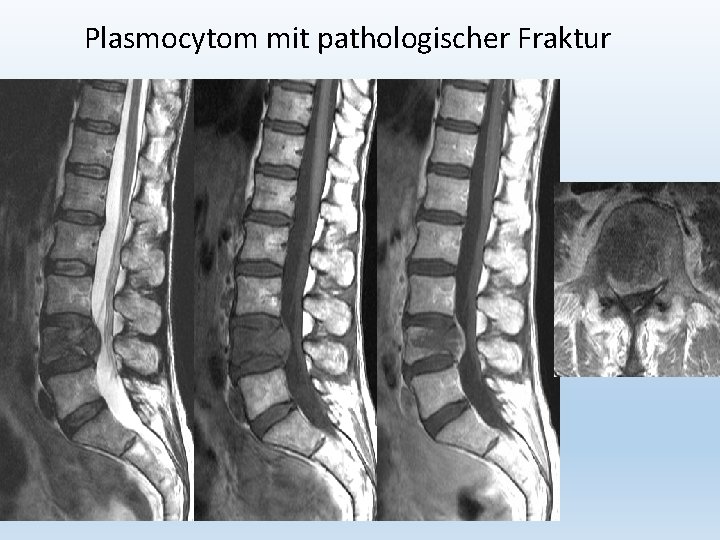 Plasmocytom mit pathologischer Fraktur 