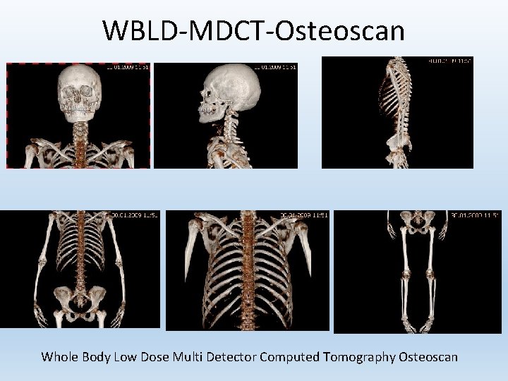 WBLD-MDCT-Osteoscan Whole Body Low Dose Multi Detector Computed Tomography Osteoscan 