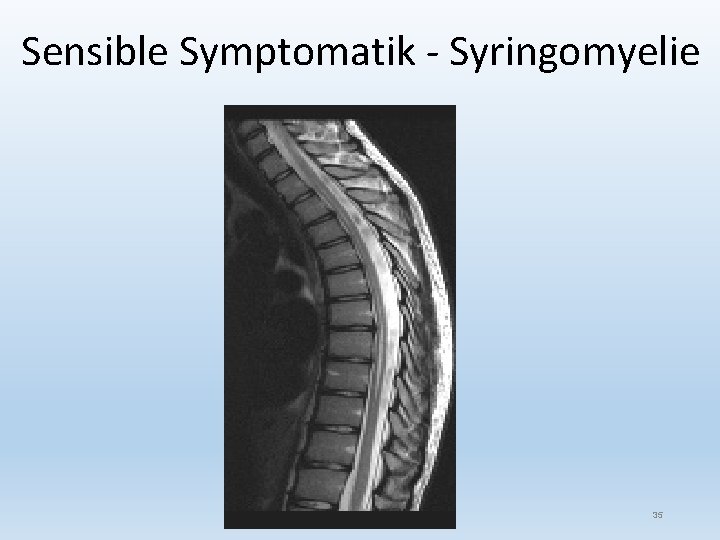 Sensible Symptomatik - Syringomyelie 35 