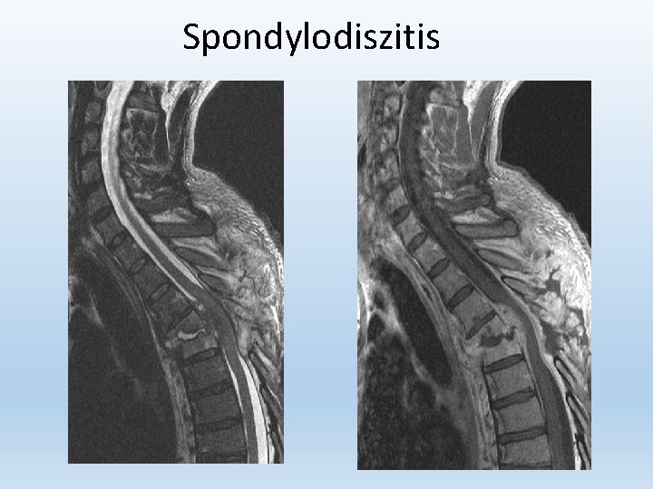 Spondylodiszitis 