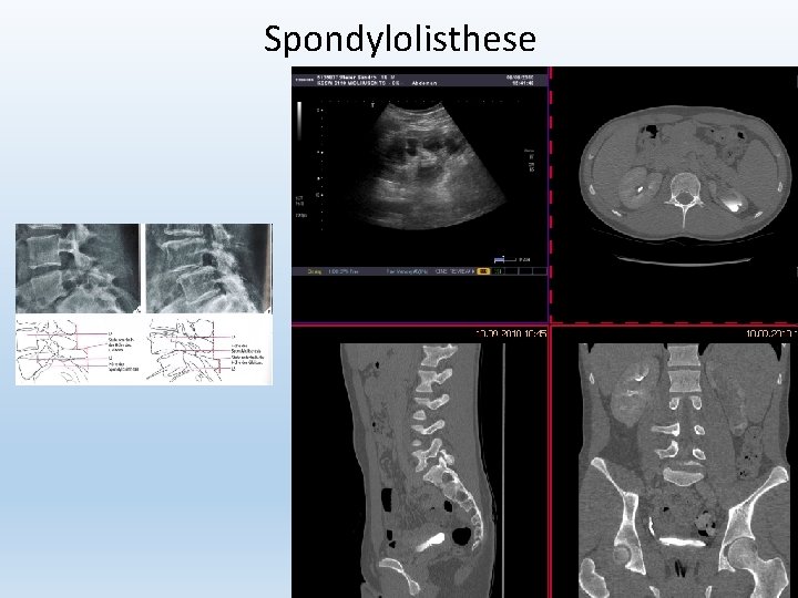 Spondylolisthese 38 