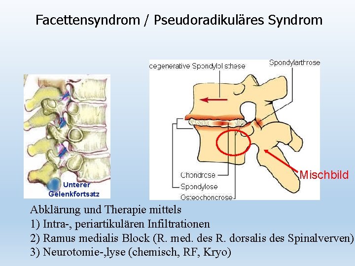 Facettensyndrom / Pseudoradikuläres Syndrom Mischbild Abklärung und Therapie mittels 1) Intra-, periartikulären Infiltrationen 2)