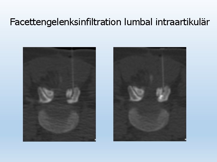 Facettengelenksinfiltration lumbal intraartikulär 