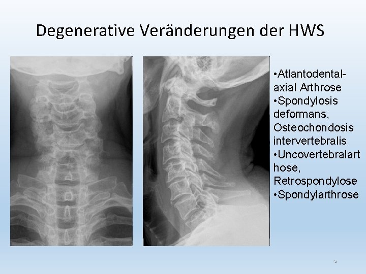 Degenerative Veränderungen der HWS • Atlantodentalaxial Arthrose • Spondylosis deformans, Osteochondosis intervertebralis • Uncovertebralart