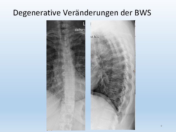 Degenerative Veränderungen der BWS 6 