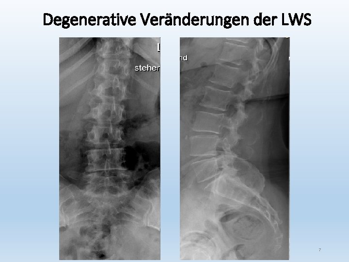 Degenerative Veränderungen der LWS 7 