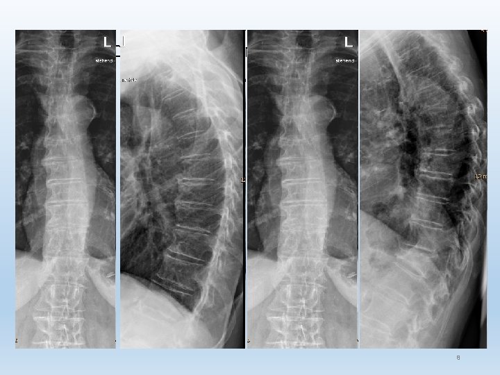 Osteoporotische Kompressionsfraktur 8 