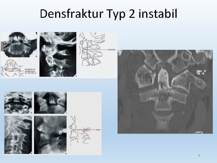 Densfraktur Typ 2 instabil 9 