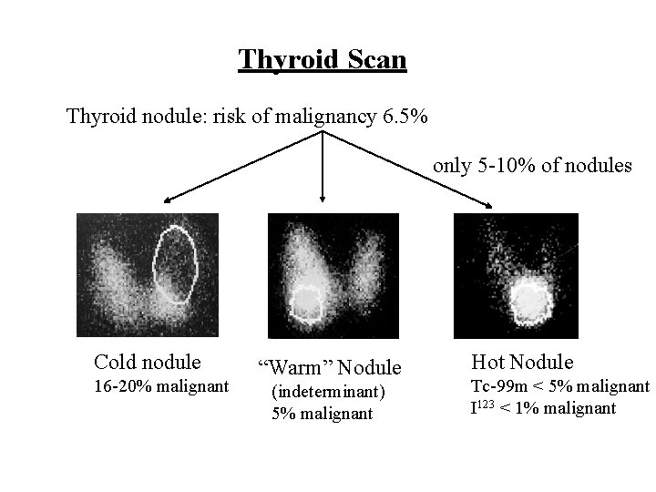 Thyroid Scan Thyroid nodule: risk of malignancy 6. 5% only 5 -10% of nodules
