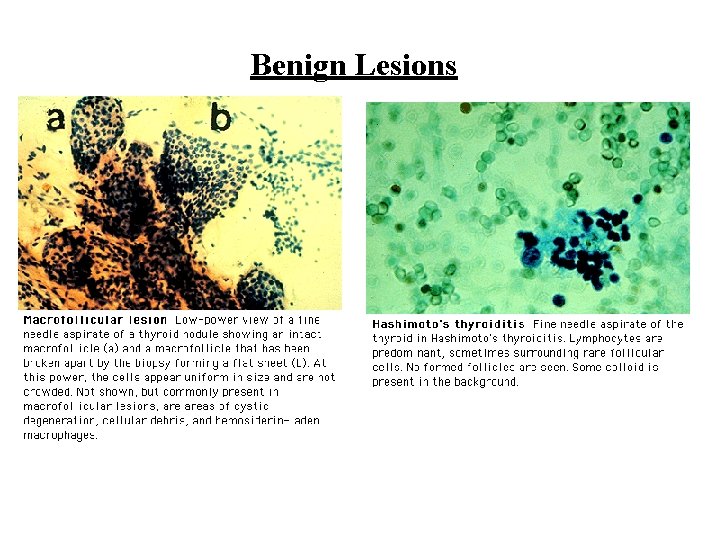 Benign Lesions 