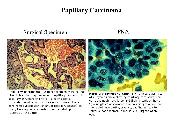 Papillary Carcinoma Surgical Specimen FNA 