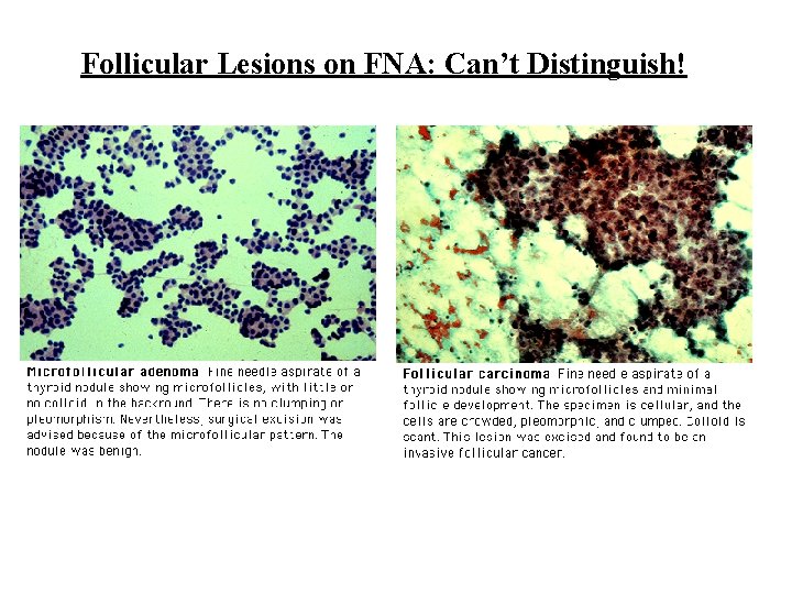 Follicular Lesions on FNA: Can’t Distinguish! 