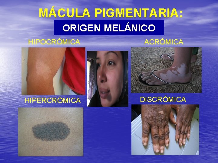 MÁCULA PIGMENTARIA: ORIGEN MELÁNICO HIPOCRÓMICA ACRÓMICA HIPERCRÒMICA DISCRÓMICA 