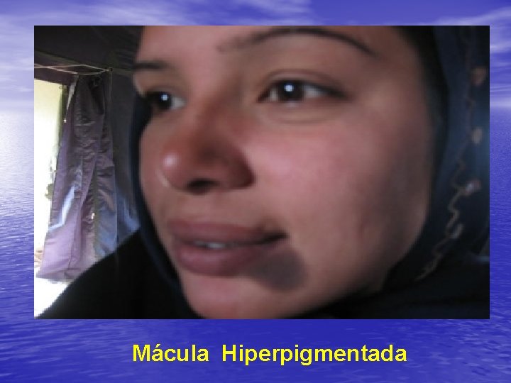 Mácula Hiperpigmentada 