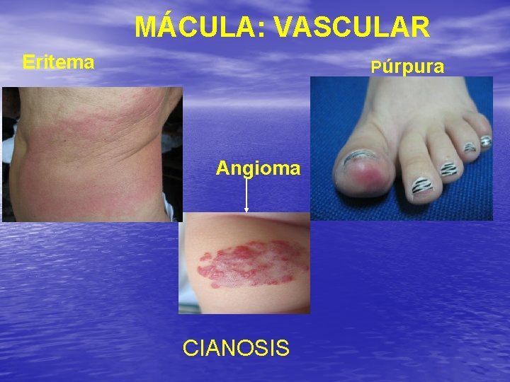 MÁCULA: VASCULAR Eritema Púrpura Angioma CIANOSIS 