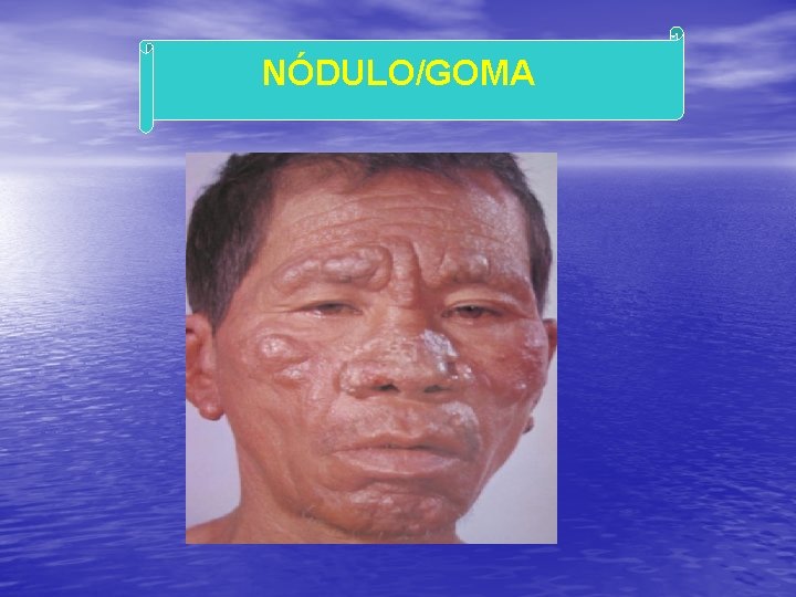 NÓDULO/GOMA 