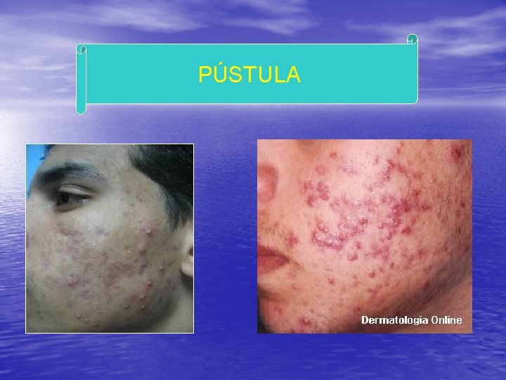 PÚSTULA 