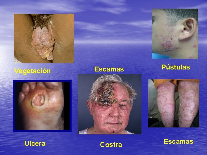 Vegetación Ulcera Escamas Costra Pústulas Escamas 
