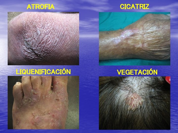 ATROFIA LIQUENIFICACIÓN CICATRIZ VEGETACIÓN 