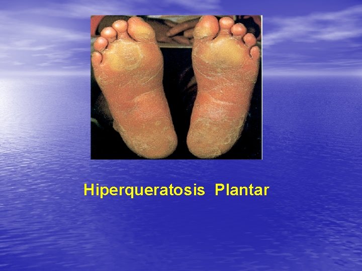 Hiperqueratosis Plantar 