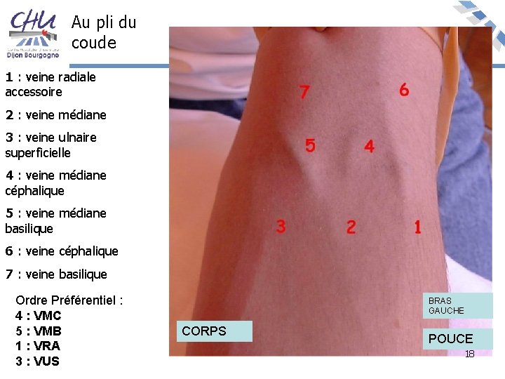 Au pli du coude 1 : veine radiale accessoire 2 : veine médiane 3