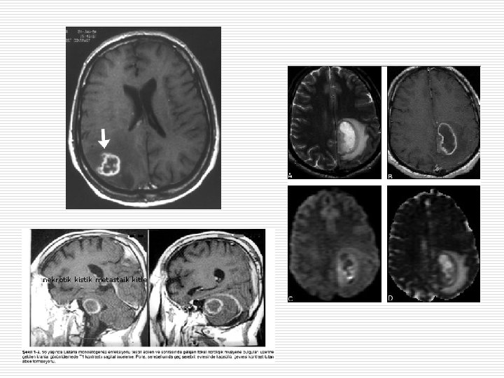 nekrotik kistik metastaik kitle 