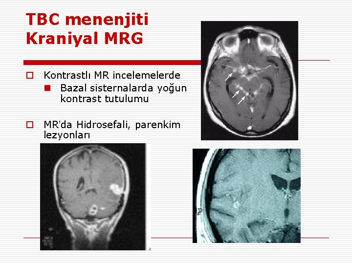 TBC menenjiti Kraniyal MRG o Kontrastlı MR incelemelerde n Bazal sisternalarda yoğun kontrast tutulumu