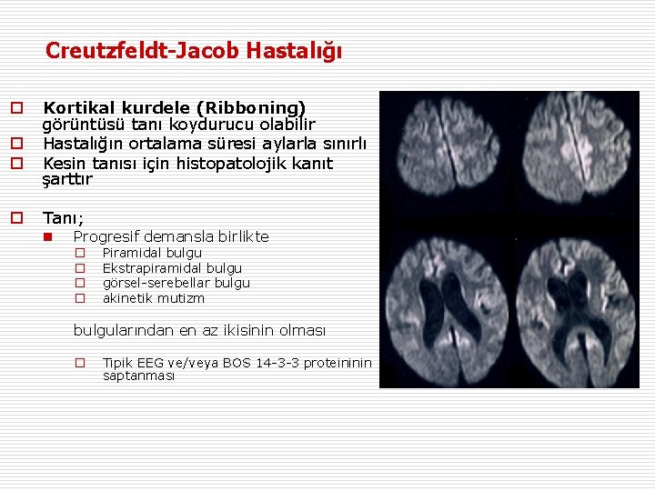 Creutzfeldt-Jacob Hastalığı o o Kortikal kurdele (Ribboning) görüntüsü tanı koydurucu olabilir Hastalığın ortalama süresi