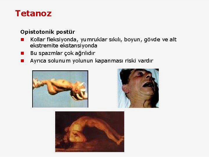 Tetanoz Opistotonik postür n Kollar fleksiyonda, yumruklar sıkılı, boyun, gövde ve alt ekstremite ekstansiyonda