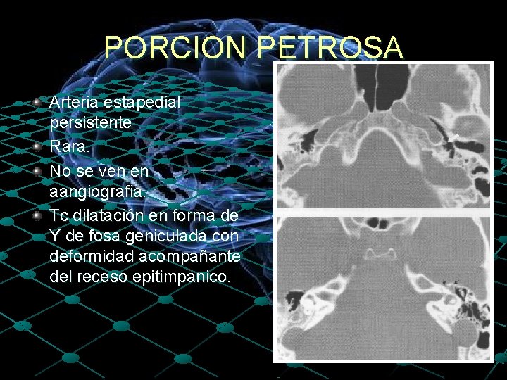 PORCION PETROSA Arteria estapedial persistente Rara. No se ven en aangiografia. Tc dilatación en
