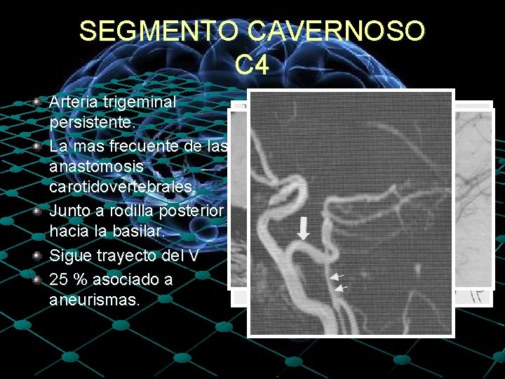 SEGMENTO CAVERNOSO C 4 Arteria trigeminal persistente. La mas frecuente de las anastomosis carotidovertebrales.