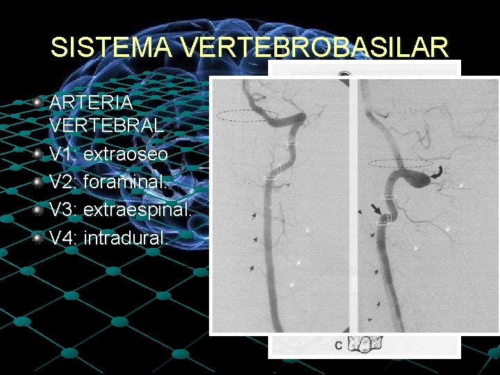 SISTEMA VERTEBROBASILAR ARTERIA VERTEBRAL V 1: extraoseo V 2: foraminal. V 3: extraespinal. V