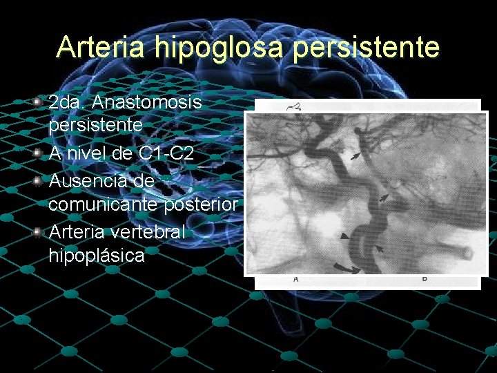 Arteria hipoglosa persistente 2 da. Anastomosis persistente A nivel de C 1 -C 2