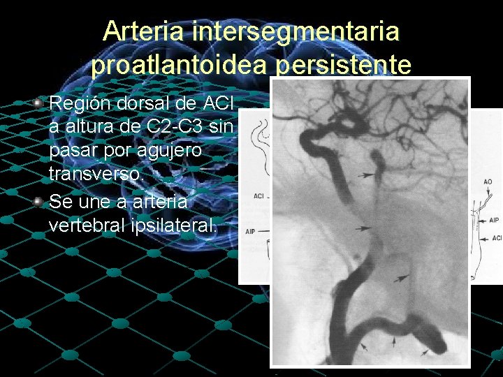 Arteria intersegmentaria proatlantoidea persistente Región dorsal de ACI a altura de C 2 -C