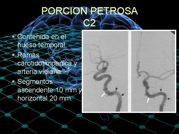 PORCION PETROSA C 2 Contenida en el hueso temporal. Ramas carotidotimpanica y arteria vidiana.