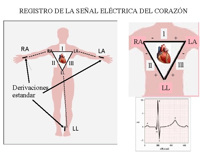 REGISTRO DE LA SEÑAL ELÉCTRICA DEL CORAZÓN RA ll LA lll l - lll