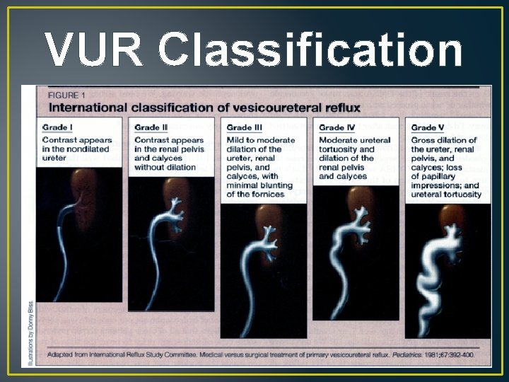 VUR Classification 