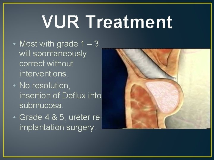 VUR Treatment • Most with grade 1 – 3 will spontaneously correct without interventions.