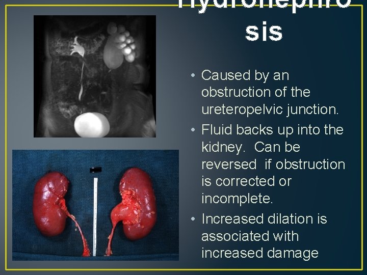 Hydronephro sis • Caused by an obstruction of the ureteropelvic junction. • Fluid backs