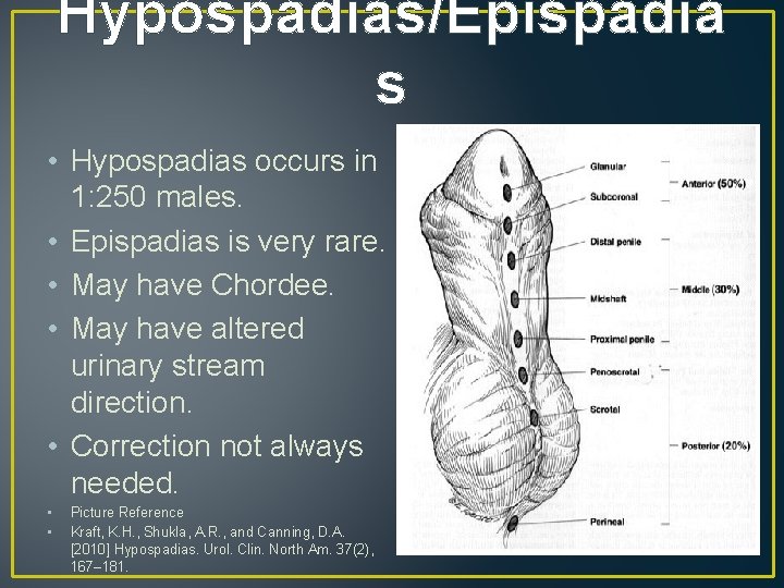 Hypospadias/Epispadia s • Hypospadias occurs in 1: 250 males. • Epispadias is very rare.