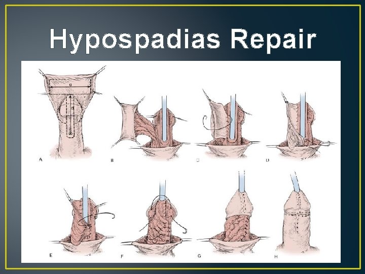 Hypospadias Repair 