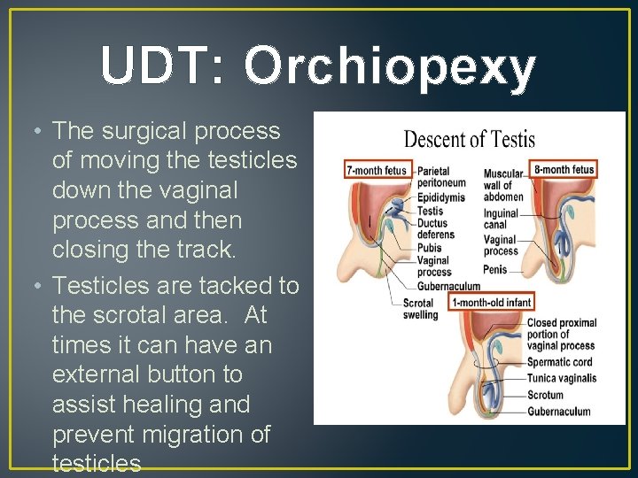 UDT: Orchiopexy • The surgical process of moving the testicles down the vaginal process