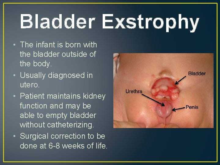 Bladder Exstrophy • The infant is born with the bladder outside of the body.