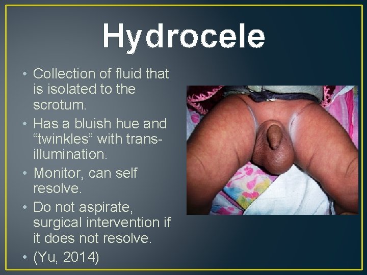 Hydrocele • Collection of fluid that is isolated to the scrotum. • Has a