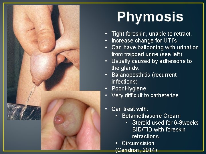 Phymosis • Tight foreskin, unable to retract. • Increase change for UTI’s • Can