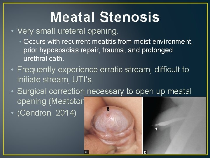 Meatal Stenosis • Very small ureteral opening. • Occurs with recurrent meatitis from moist