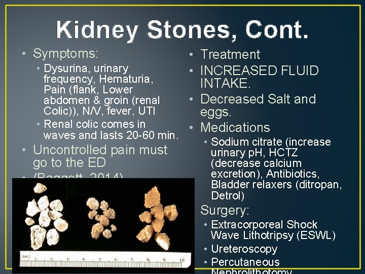 Kidney Stones, Cont. • Symptoms: • Dysurina, urinary frequency, Hematuria, Pain (flank, Lower abdomen