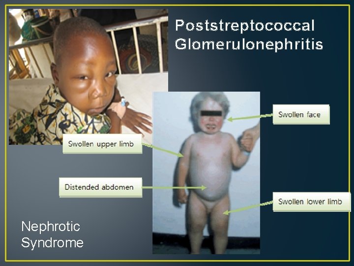 Poststreptococcal Glomerulonephritis Nephrotic Syndrome 