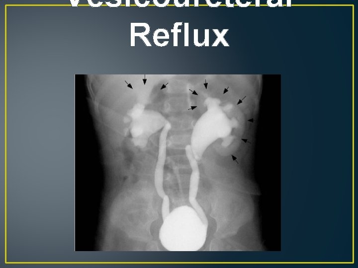 Vesicoureteral Reflux 